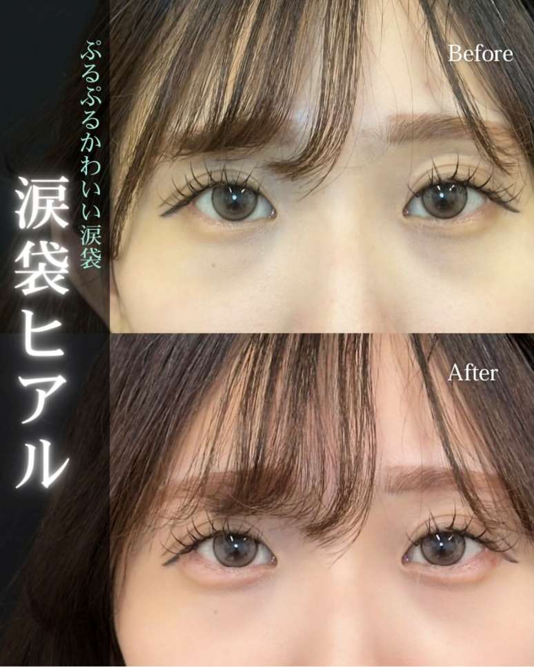 涙袋ヒアルロン酸の症例写真