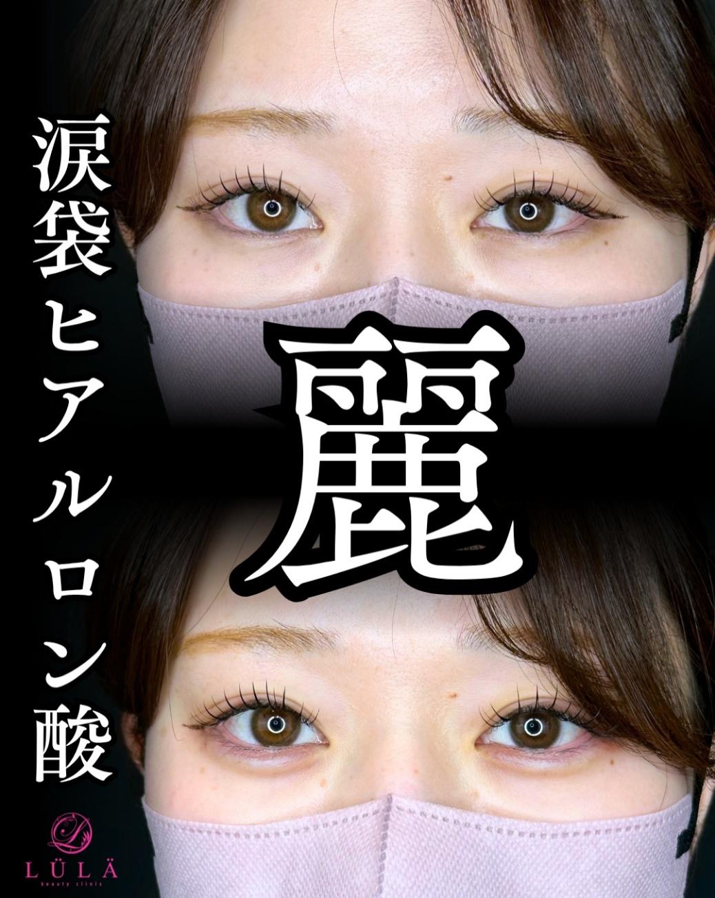 涙袋ヒアルロン酸の症例写真