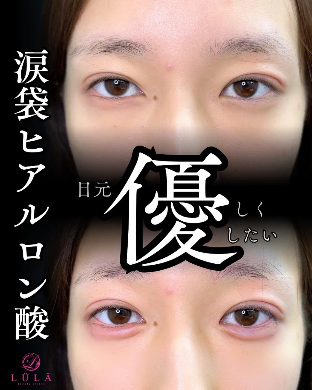 涙袋ヒアルロン酸の症例写真