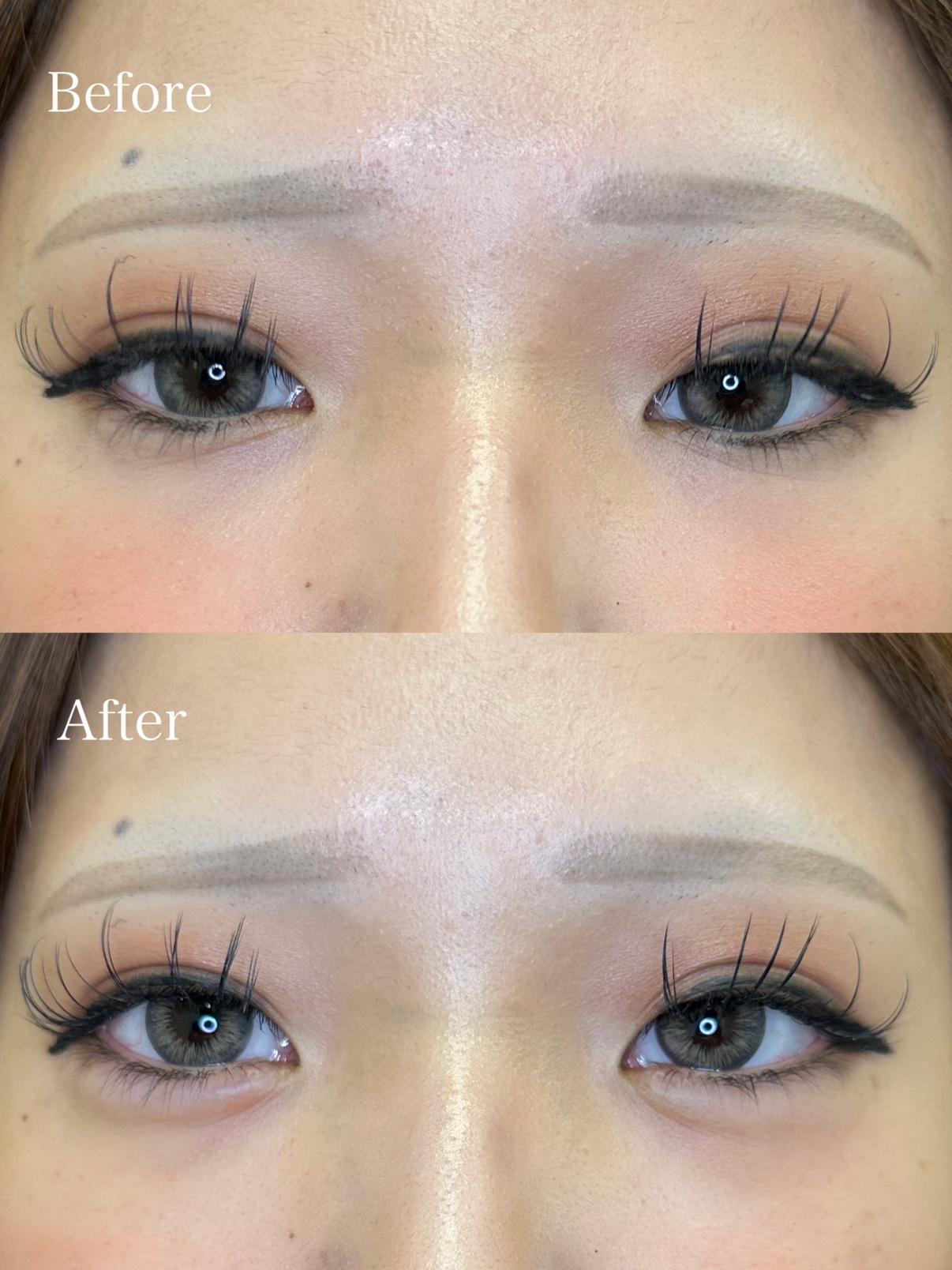 涙袋ヒアルロン酸の症例写真