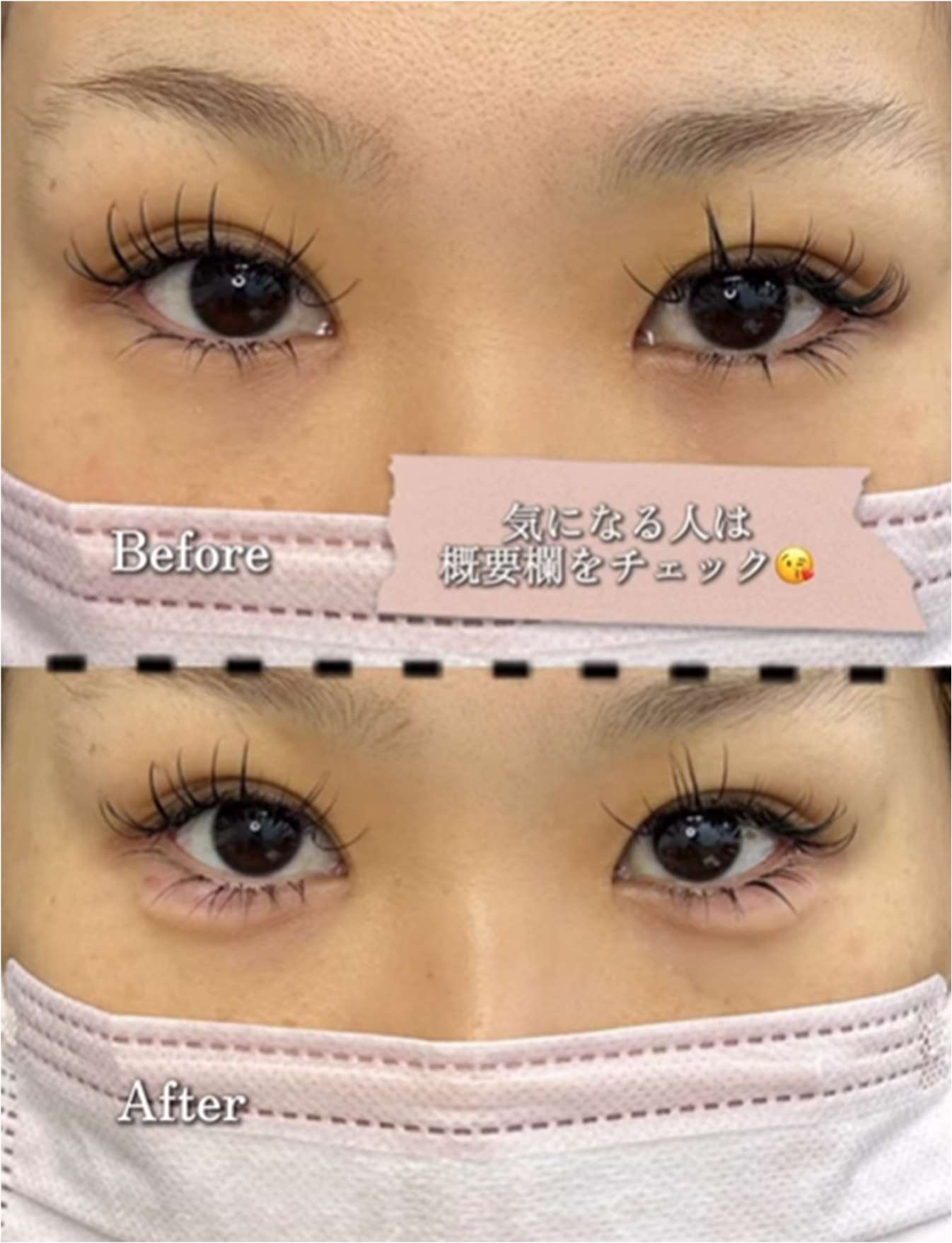 涙袋ヒアルロン酸の症例写真