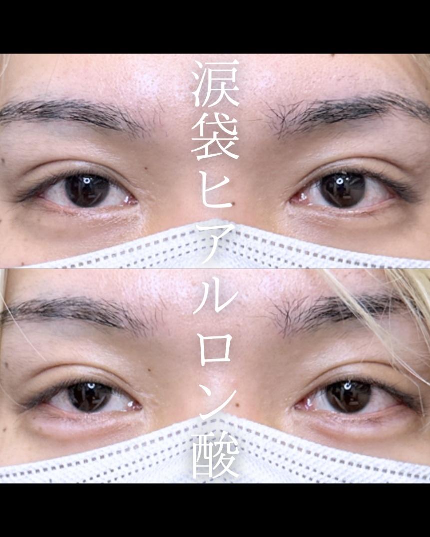 涙袋ヒアルロン酸の症例写真