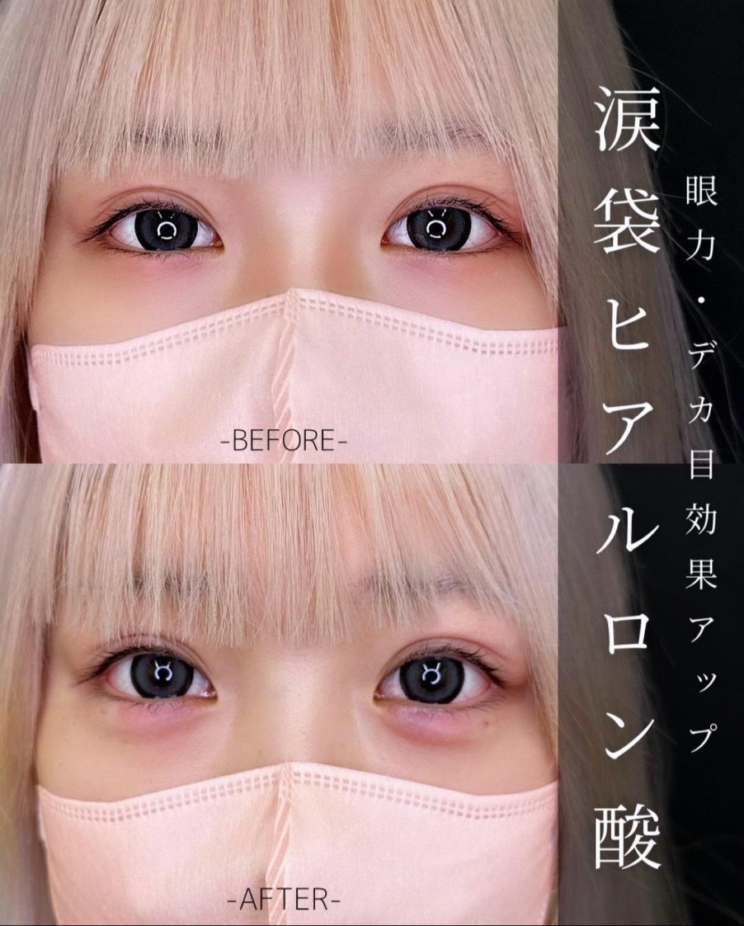 涙袋ヒアルロン酸の症例写真