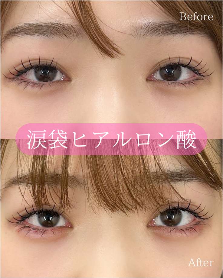 涙袋ヒアルロン酸の症例写真