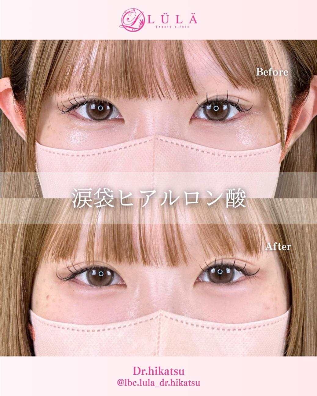 涙袋ヒアルロン酸の症例写真