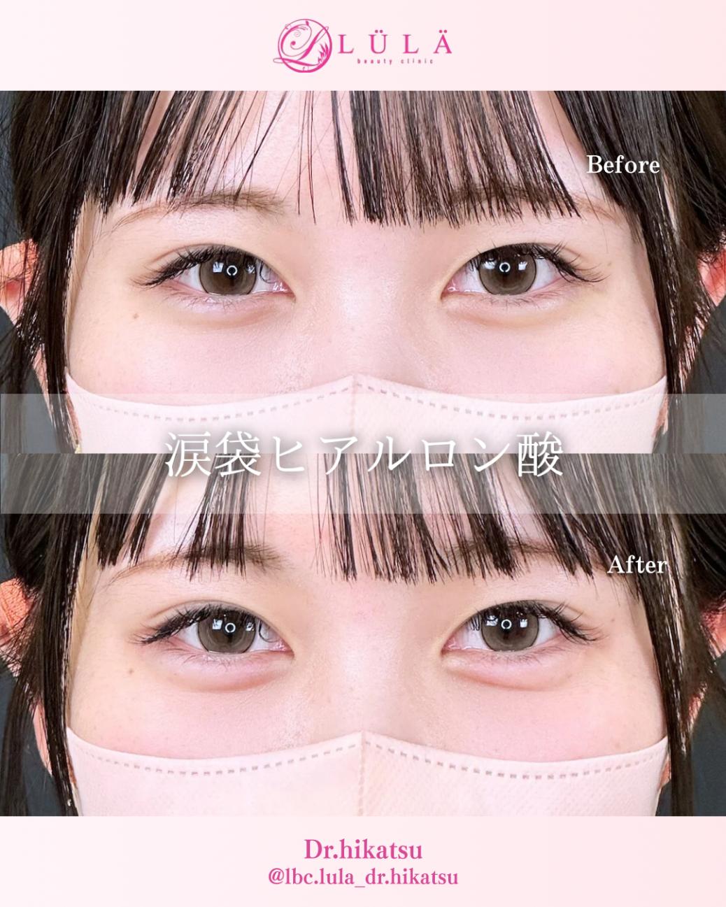 涙袋ヒアルロン酸の症例写真