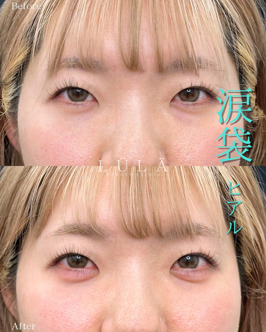 涙袋ヒアルロン酸の症例写真