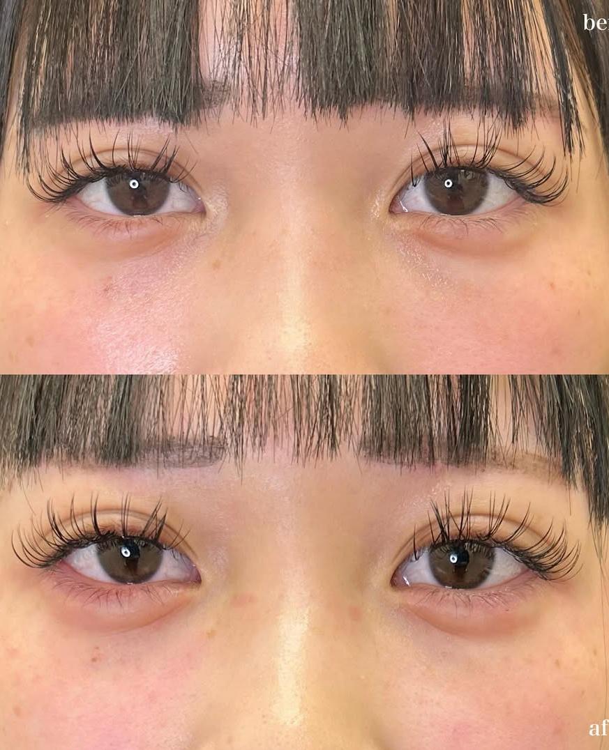 涙袋ヒアルロン酸の症例写真