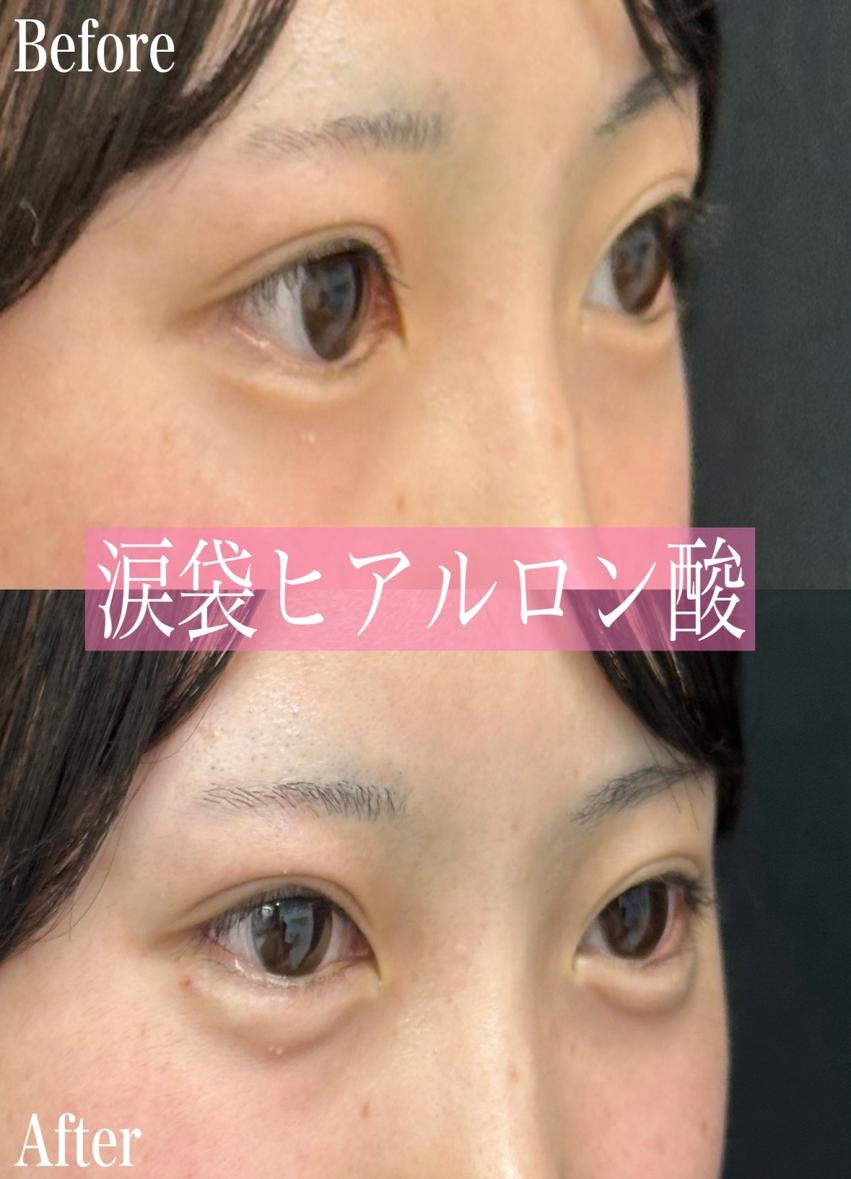 涙袋ヒアルロン酸の症例写真