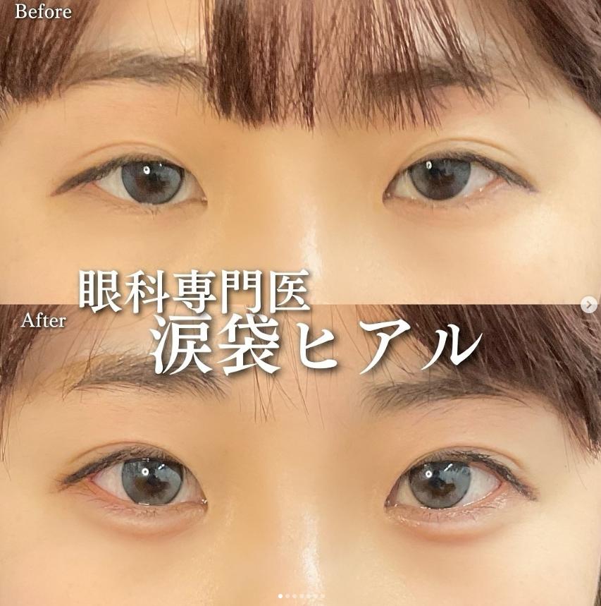 涙袋ヒアルロン酸の症例写真