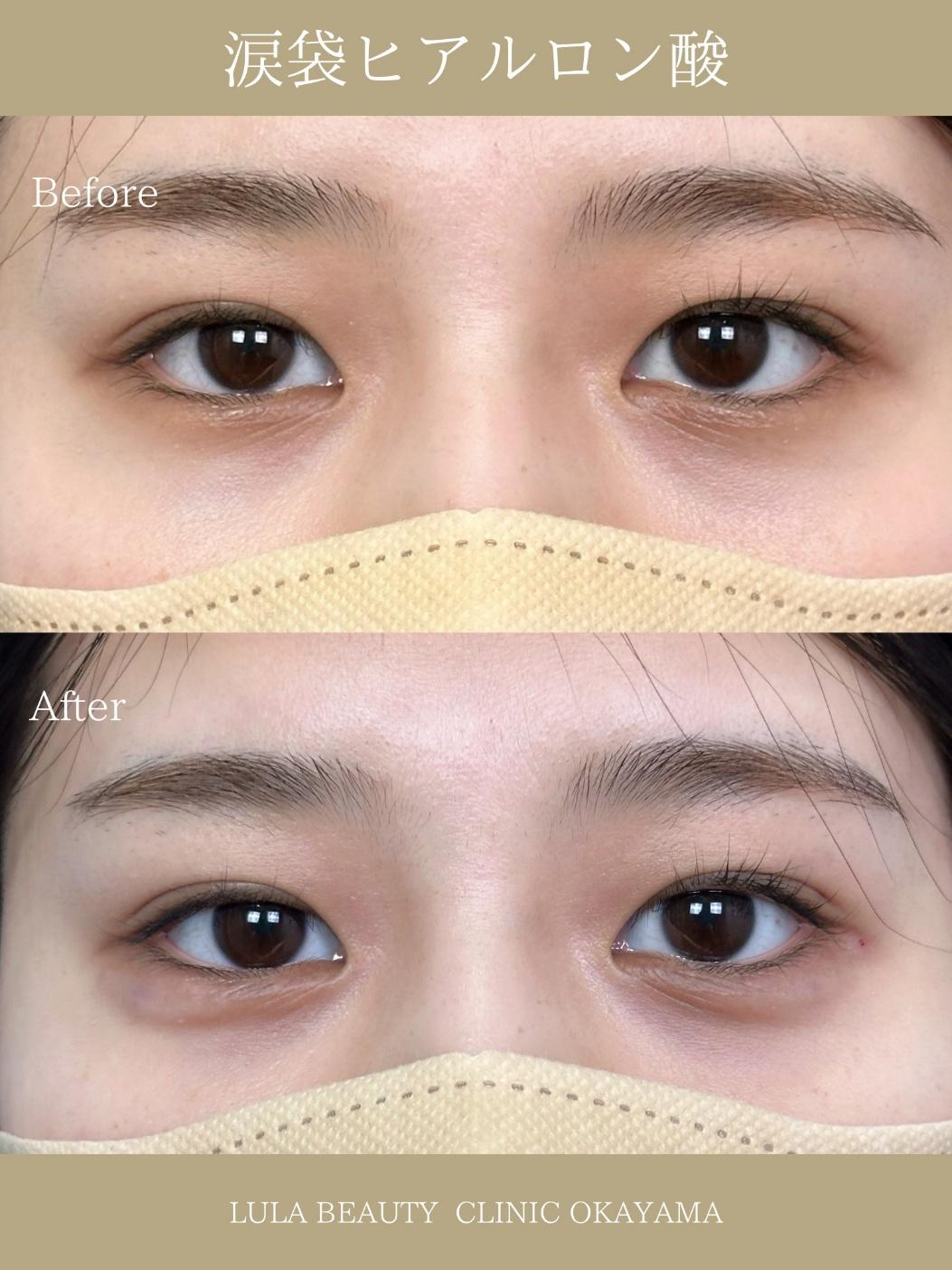 涙袋ヒアルロン酸の症例写真