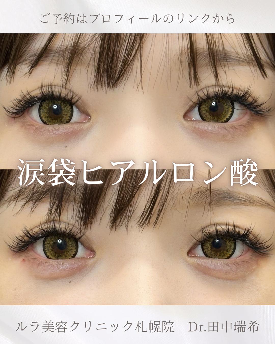 涙袋ヒアルロン酸の症例写真