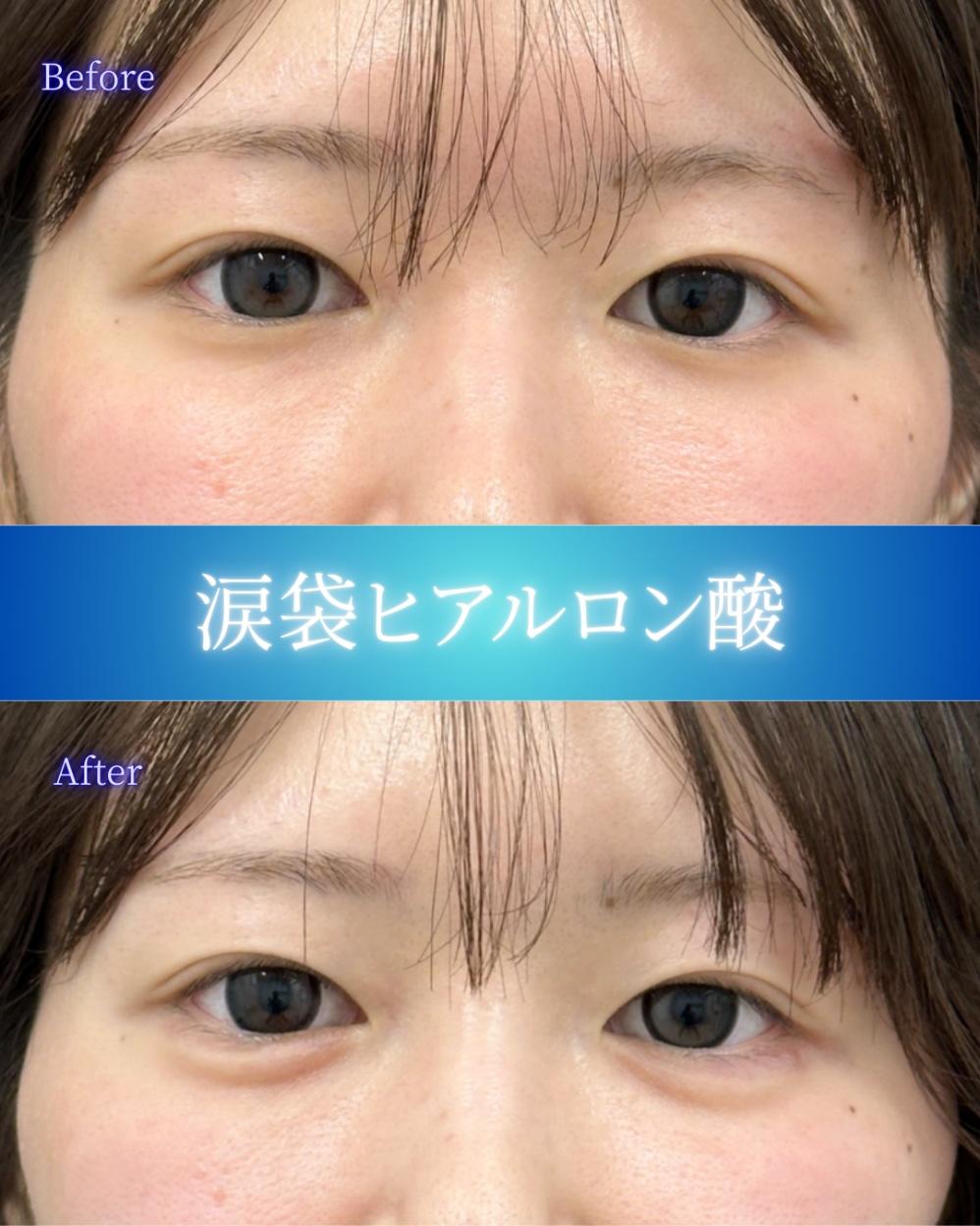 涙袋ヒアルロン酸の症例写真