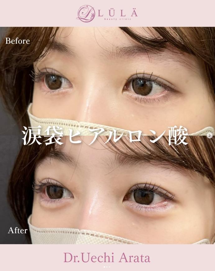 涙袋ヒアルロン酸の症例写真