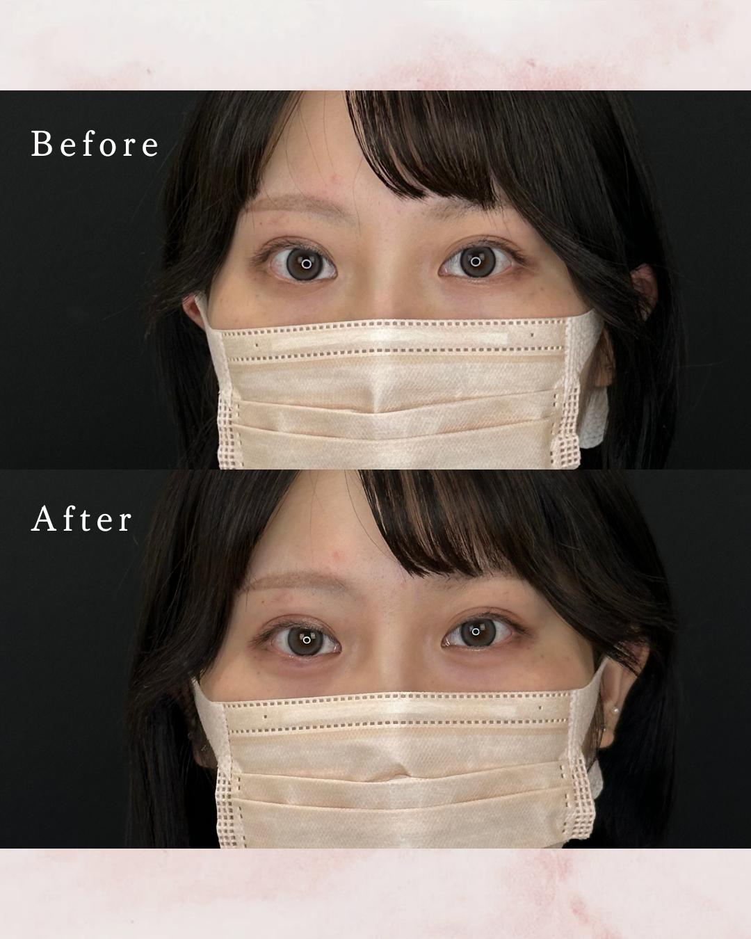 涙袋ヒアルロン酸の症例写真