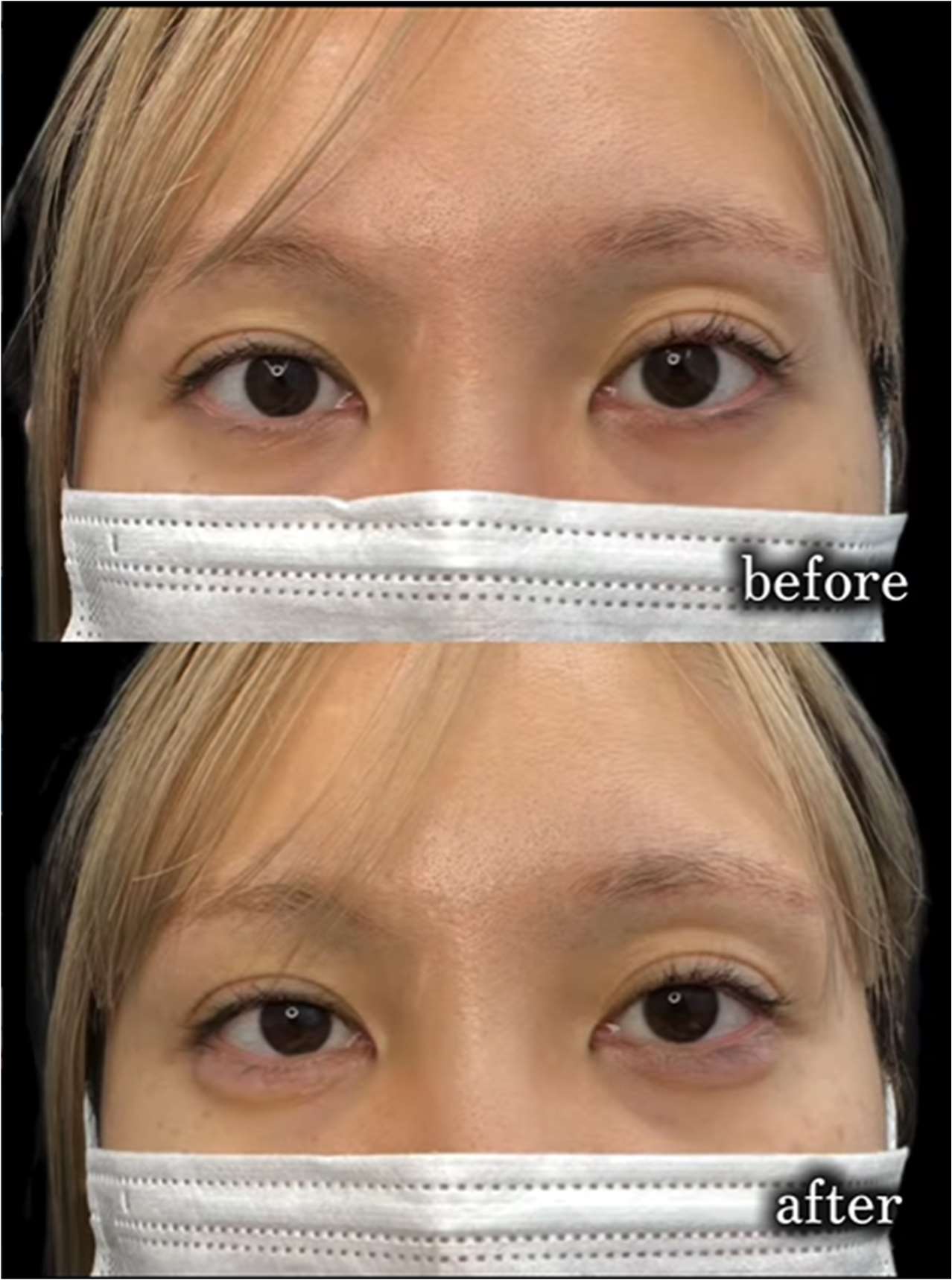 涙袋ヒアルロン酸の症例写真