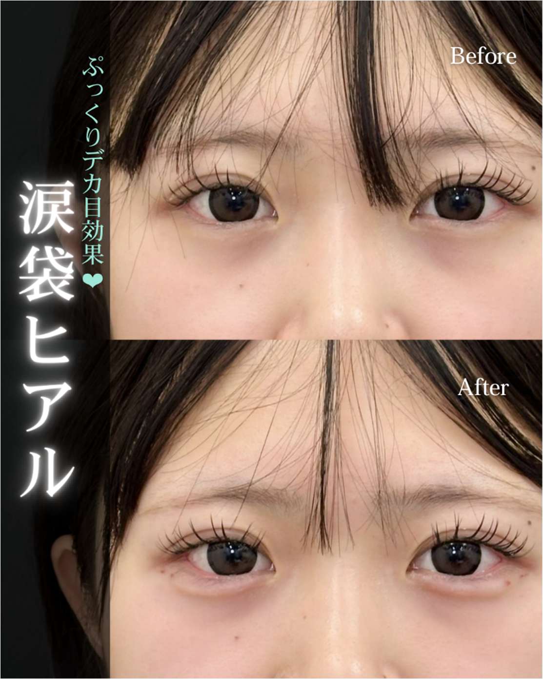 涙袋ヒアルロン酸の症例写真