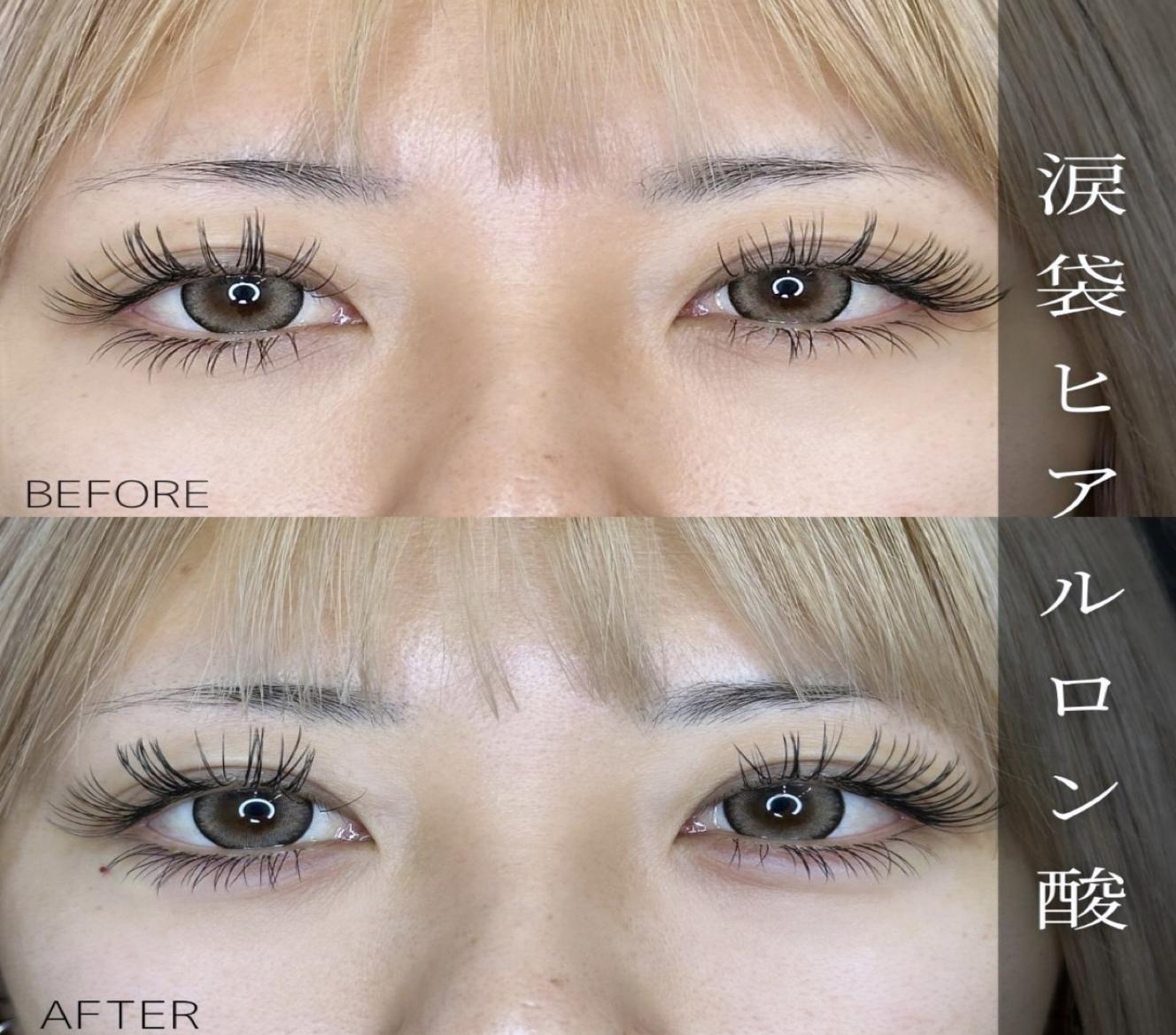 涙袋ヒアルロン酸の症例写真
