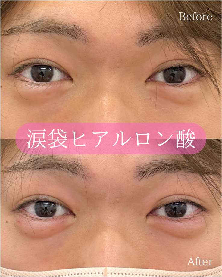 涙袋ヒアルロン酸の症例写真