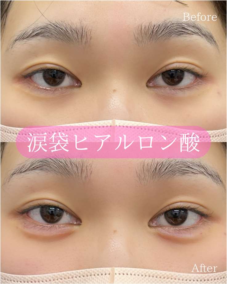 涙袋ヒアルロン酸の症例写真