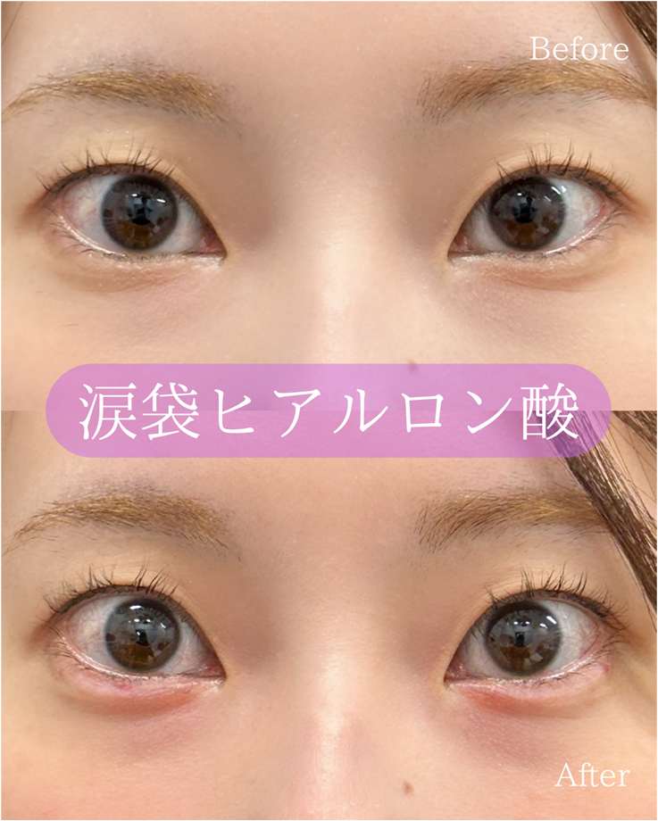 涙袋ヒアルロン酸の症例写真