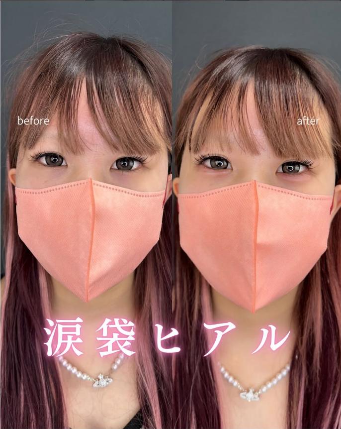 涙袋ヒアルロン酸の症例写真