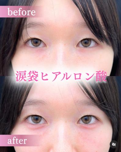 涙袋ヒアルロン酸の症例写真