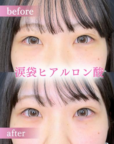 涙袋ヒアルロン酸の症例写真