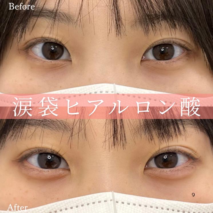 涙袋ヒアルロン酸の症例写真