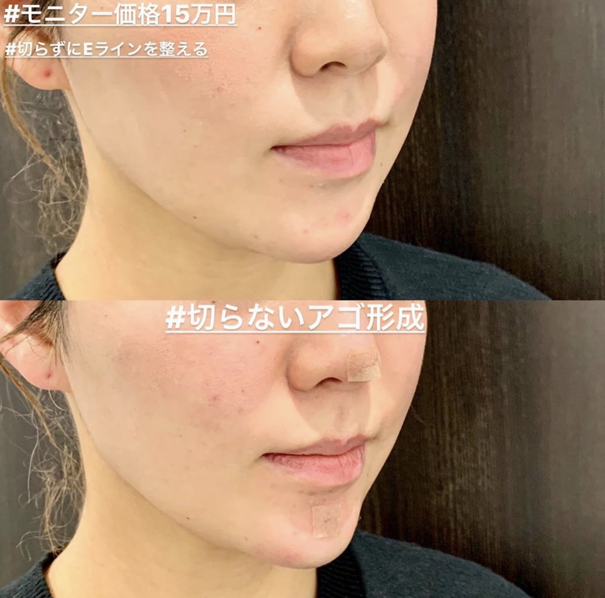 切らないアゴ形成の症例写真