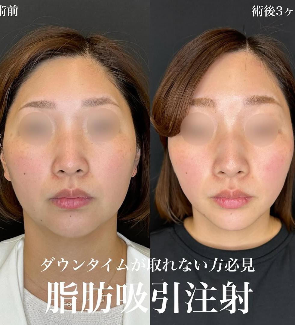 脂肪吸引の症例写真