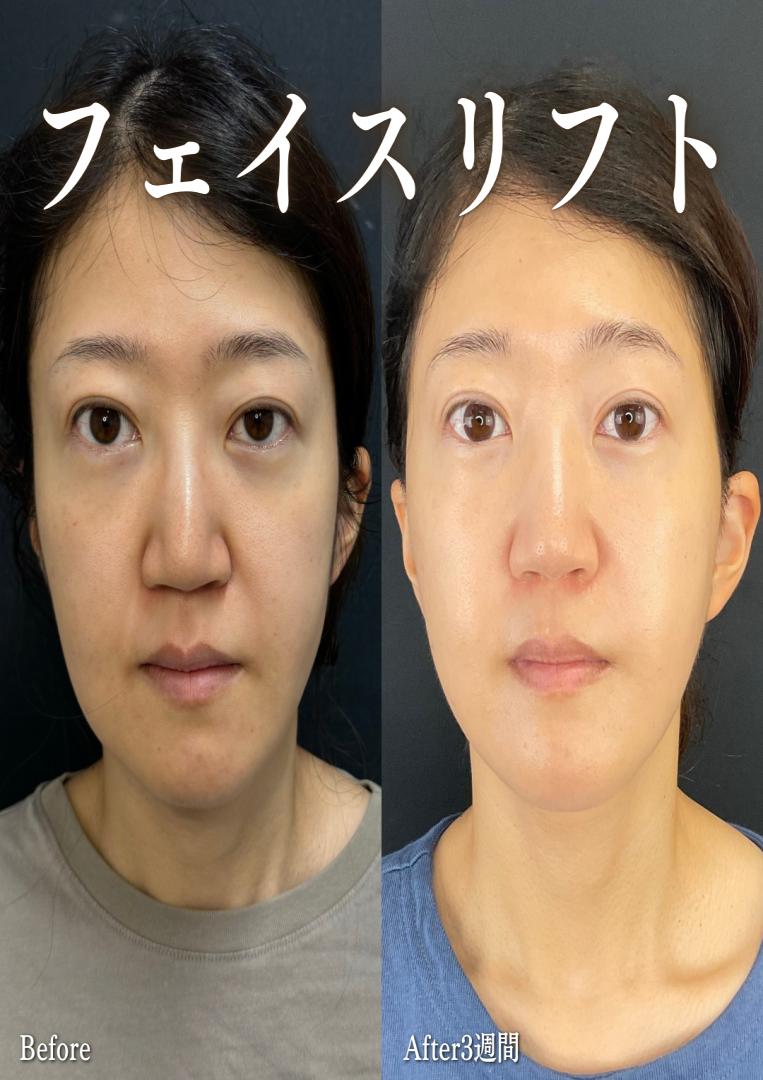 前額リフトの症例写真