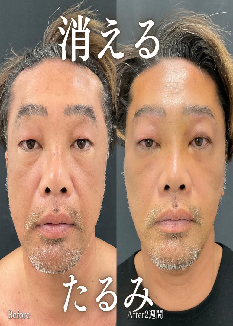 前額リフトの症例写真