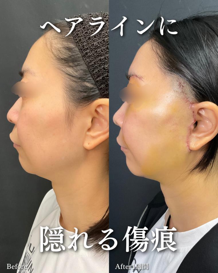 前額リフトの症例写真