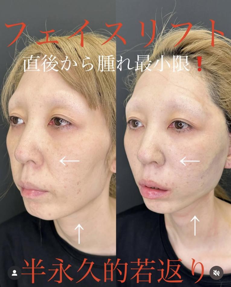 前額リフトの症例写真