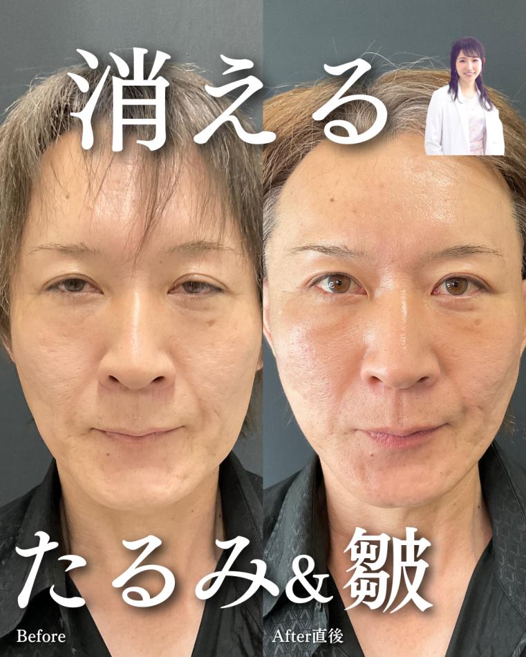 前額リフトの症例写真