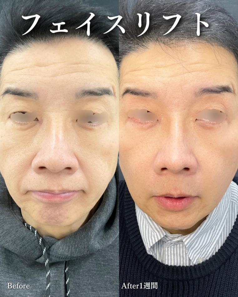 前額リフトの症例写真