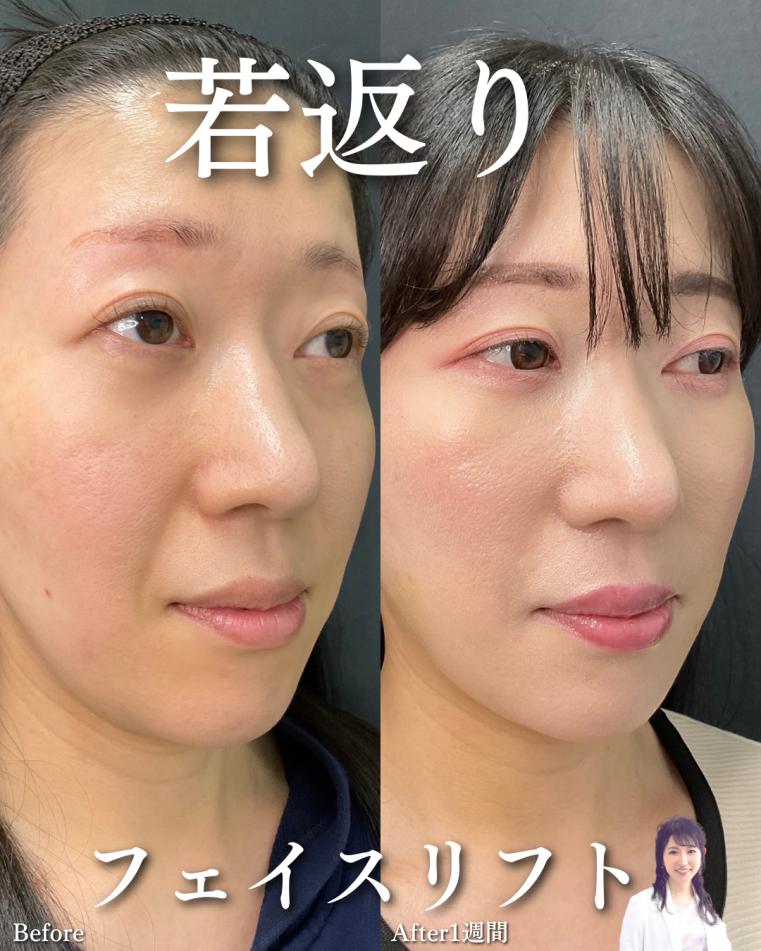 前額リフトの症例写真