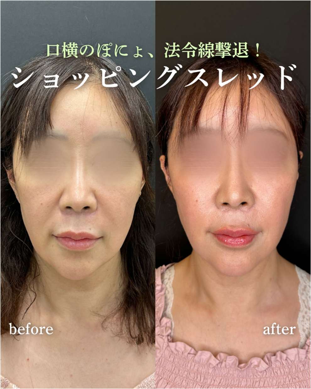 脂肪吸引の症例写真