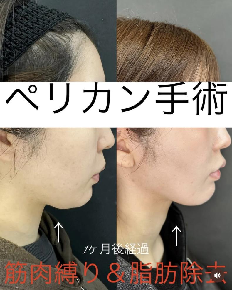 ペリカン手術の症例写真