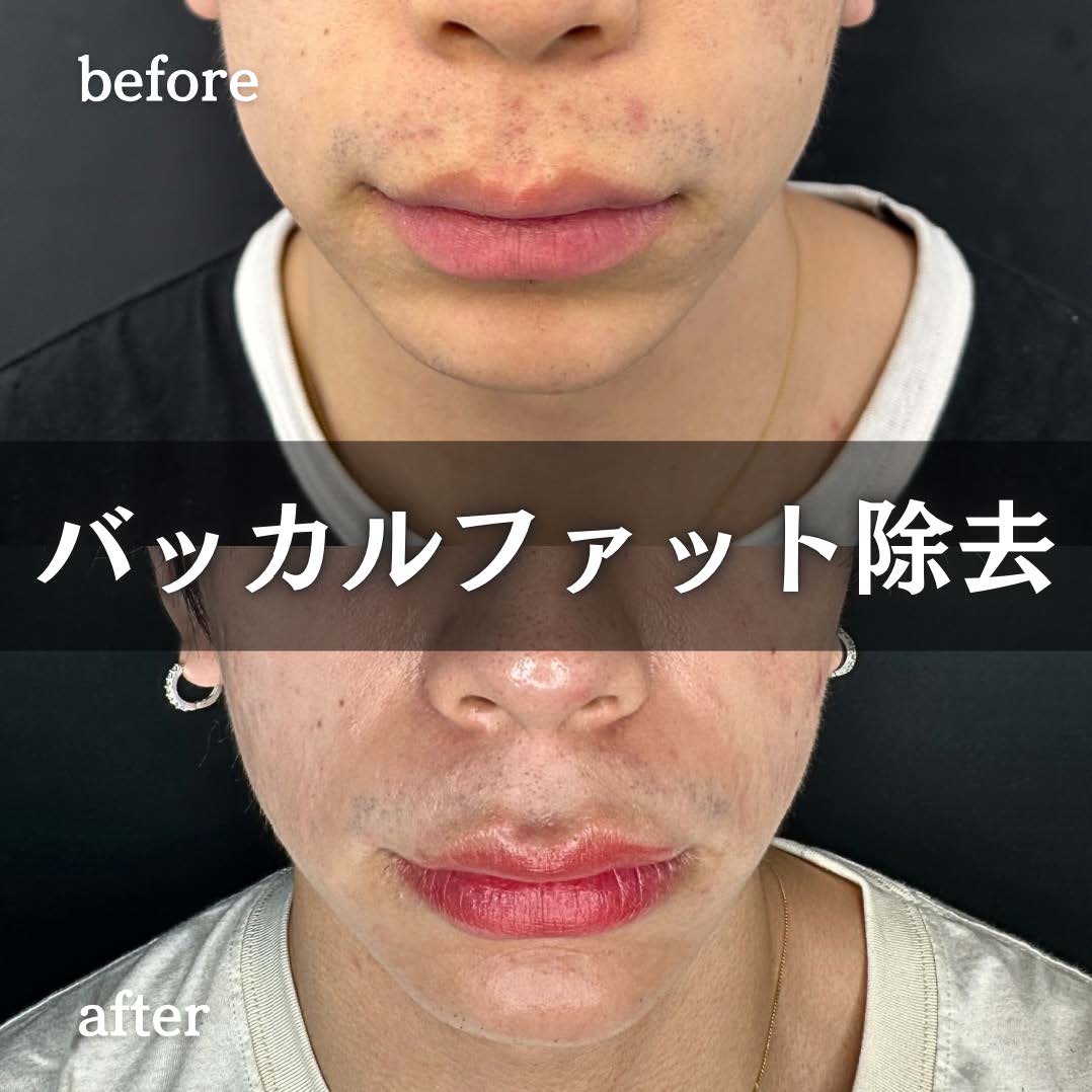 バッカルファット除去の症例写真