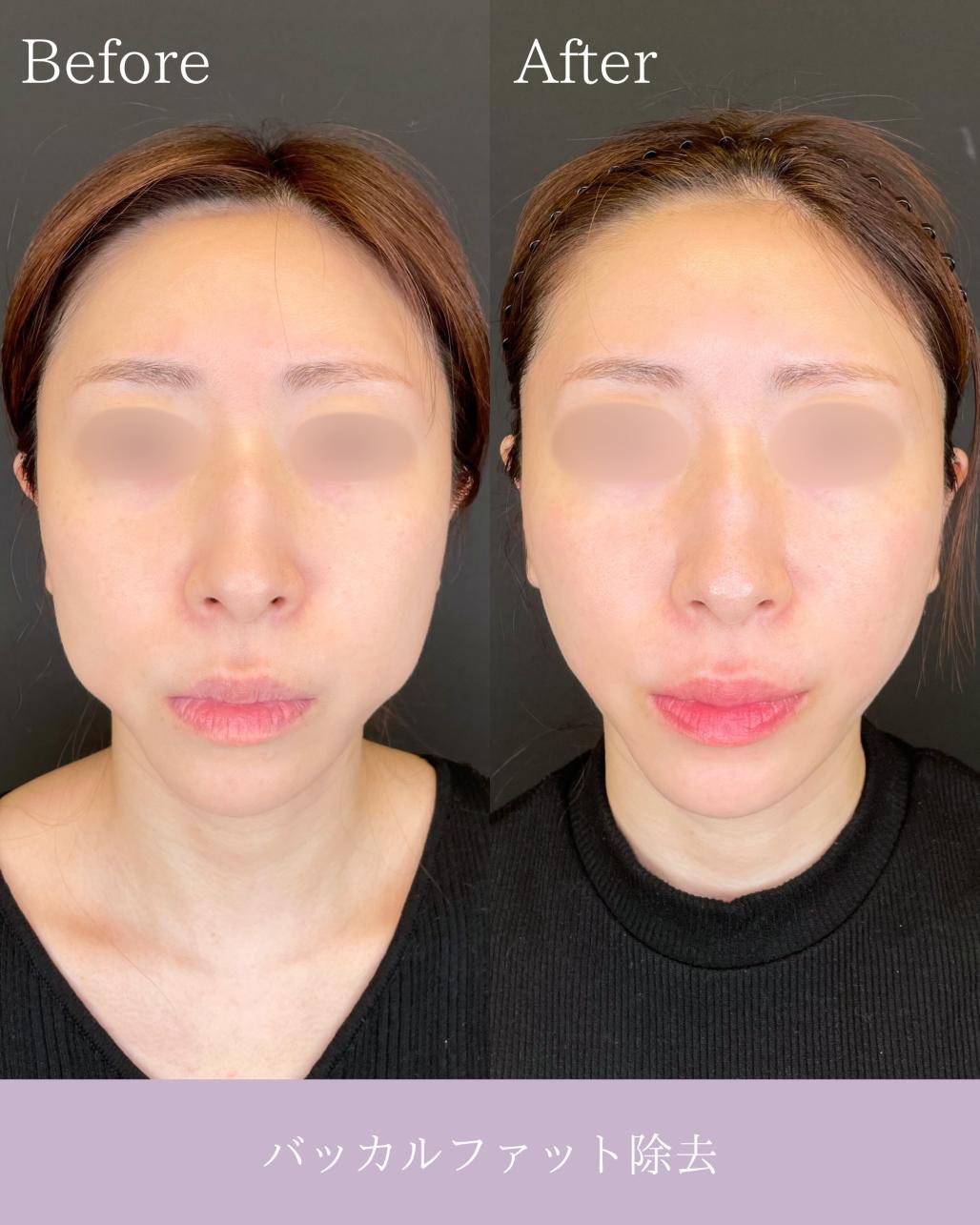 バッカルファット除去の症例写真