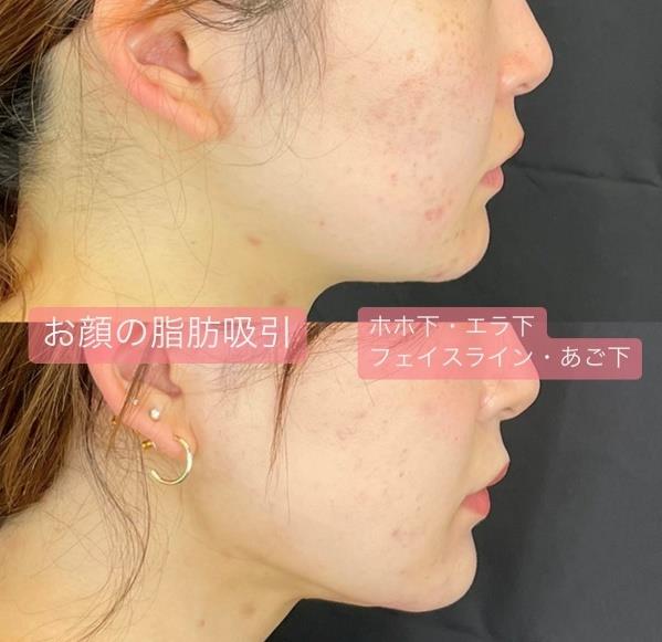 顔の脂肪吸引の症例写真