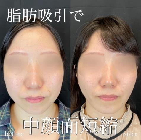 脂肪吸引の症例写真