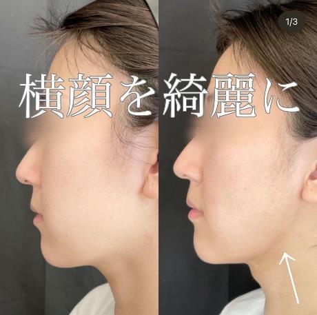 脂肪吸引の症例写真