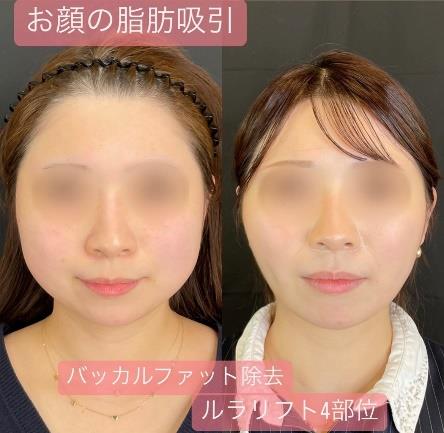 脂肪吸引の症例写真