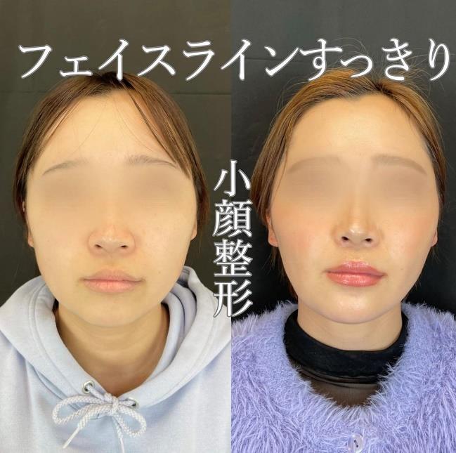 脂肪吸引の症例写真