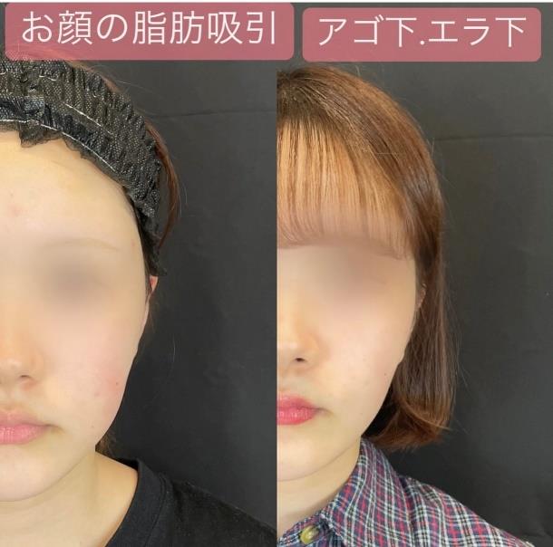 脂肪吸引の症例写真