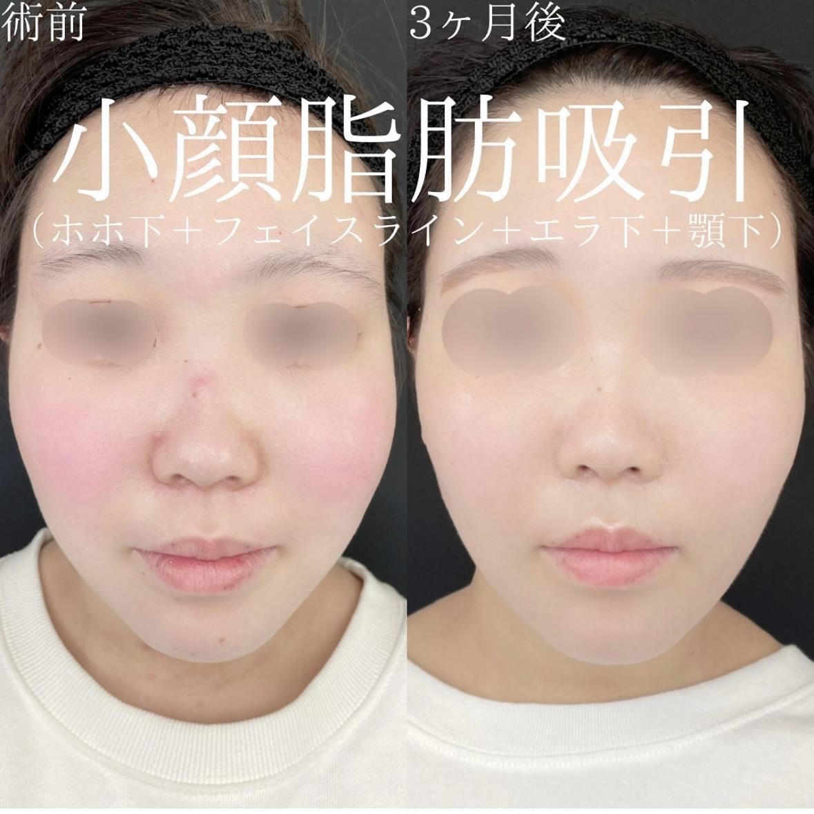 脂肪吸引の症例写真