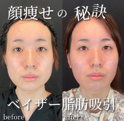 脂肪吸引の症例写真